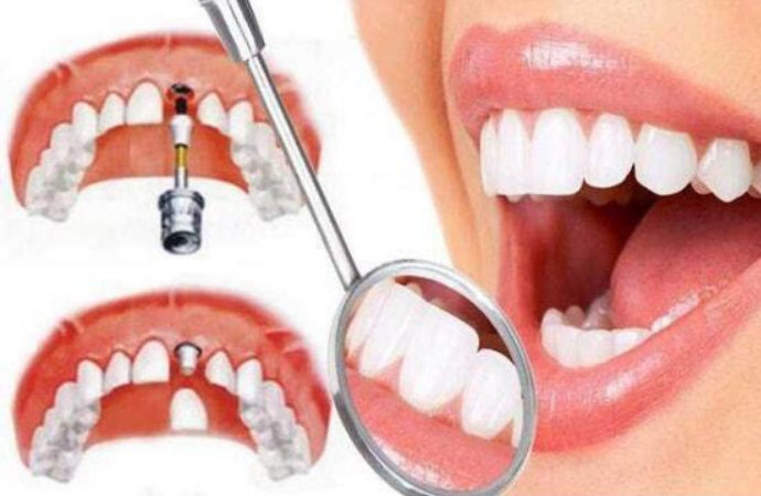 東莞生鮮配送中心為您普及：天生的牙齒和高價的種植牙哪個更好？